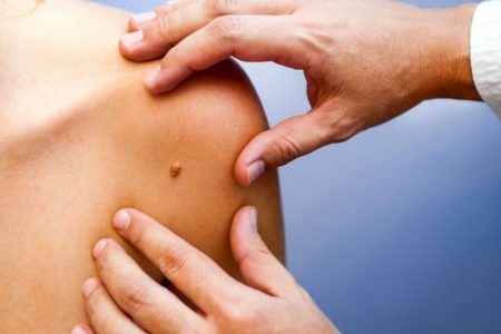 PAPILOAMELE CUTANATE – CAUZE ȘI TRATAMENT