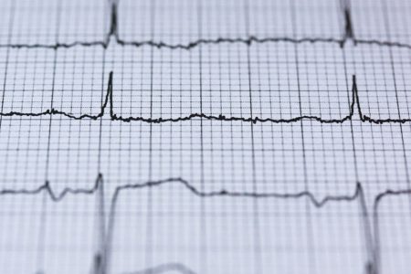 CE SUNT PALPITAȚIILE?