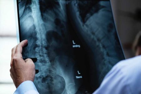 CAUZELE DURERII DE SPATE